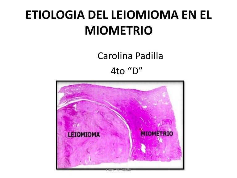 Etiologia del leiomioma en el miometrio