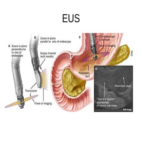 ENDOSCOPIC ULTRASOUND | PPTX