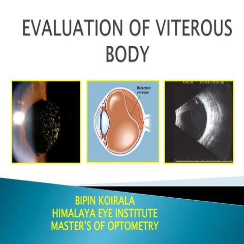 Evaluation of viterous body.pptx