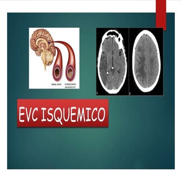 Evc isquemico 