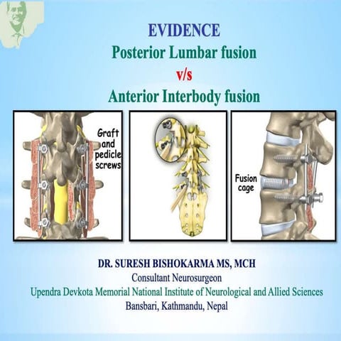 Posterior lumbar fusion vs Lumbar interbody fusion Evidence based.pptx