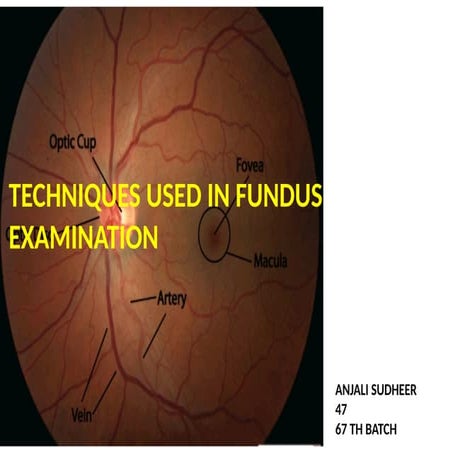 Basic fundoscopy | PPTX
