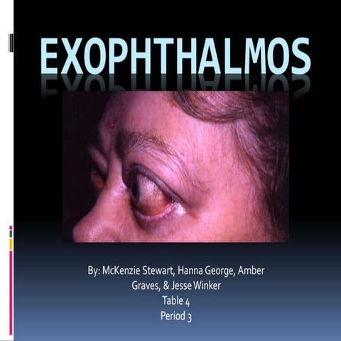 Exophthalmos