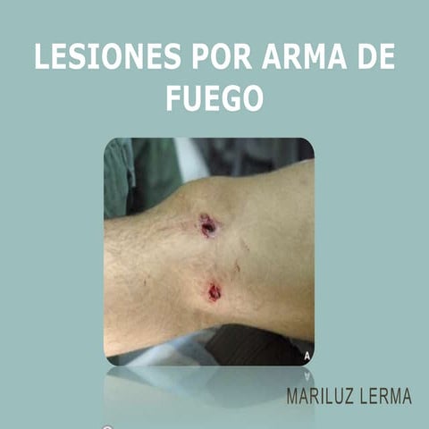 Tipos De Heridas Por Arma De Fuego es.slideshare.net