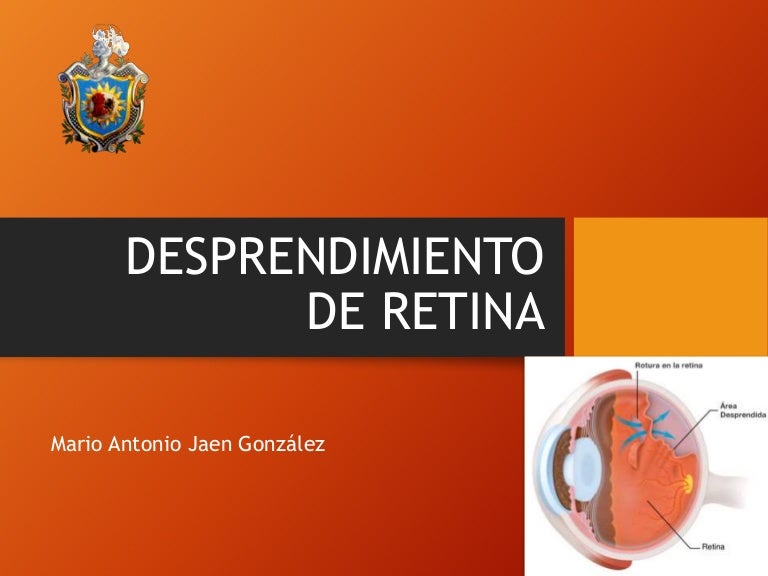 Retinosquisis cura para la diabetes Retinosquisis cura para la diabetes