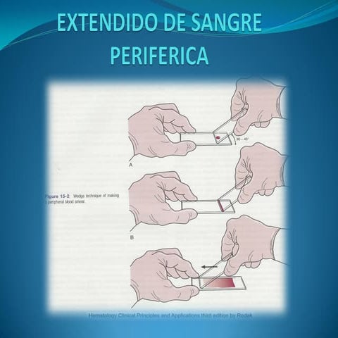 Extendido de Sangre Periferica Interpretación