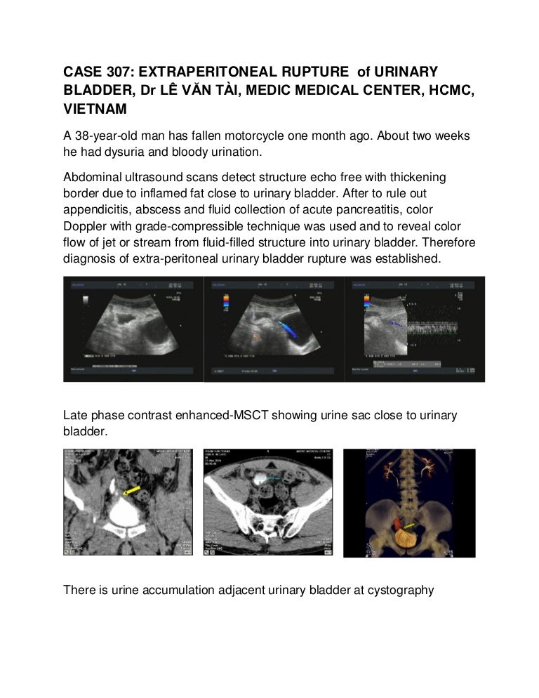 Extraperitoneal Rupture Of Urinary Bladder Dr L V N T I
