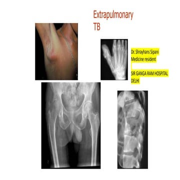 Extrapulmonary tb | PPTX