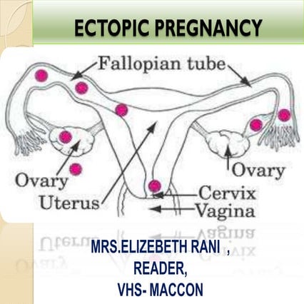 EXTRA UTERINE OR ECTOPIC  PRENANCY
