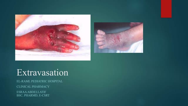 Extravasation | PPT