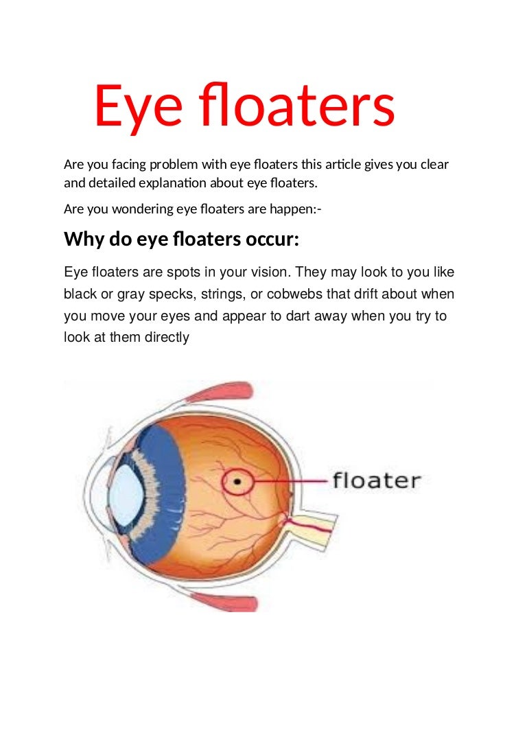 Eye floaters pdf