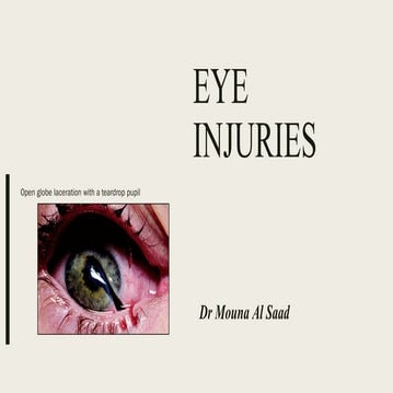 Ocular trauma | PPTX