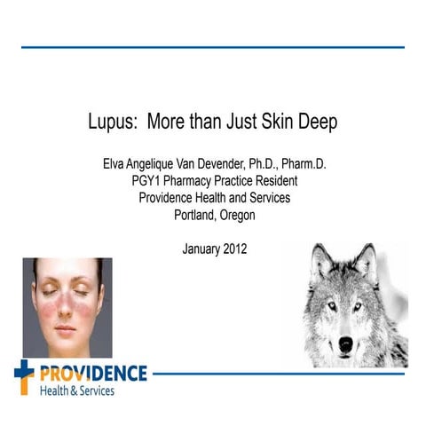 lupus presentation final