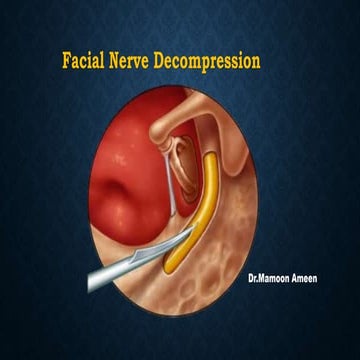 Facial nerve decompression