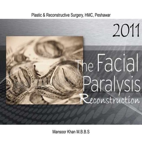 Facial paralysis reconstruction