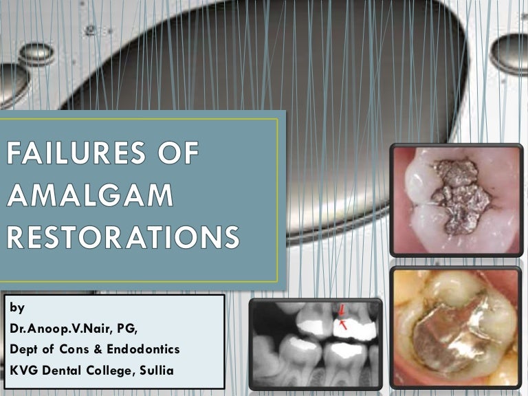 Failure of amalgam