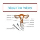 Fallopian tube problems 7 july17