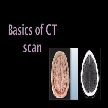 Normal CT BRAIN | PPTX