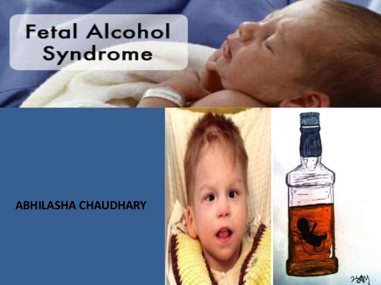 Fetal Alcohol Syndrome Fas