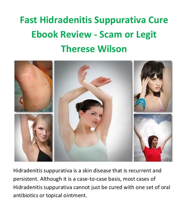 Fast hidradenitis suppurativa cure ebook by therese wilson