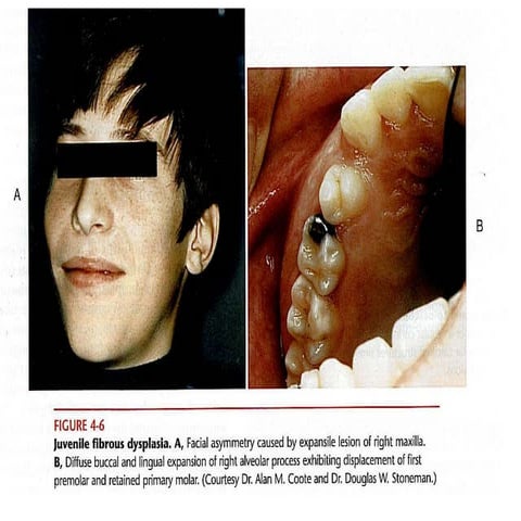 Fibro osseous lesion dina patho