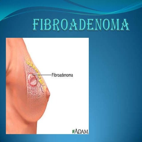 Fibroadenoma