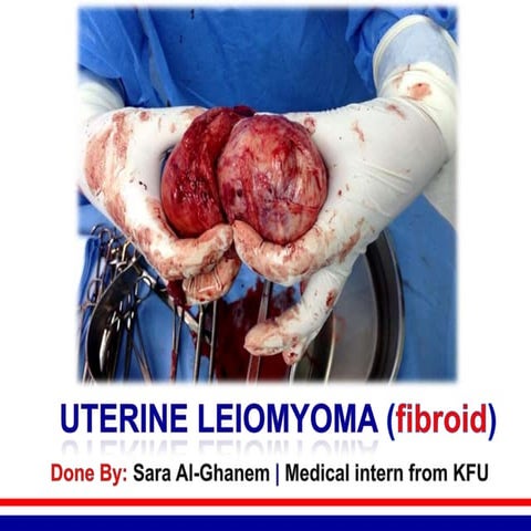 Uterine leiomyoma (fibroid)