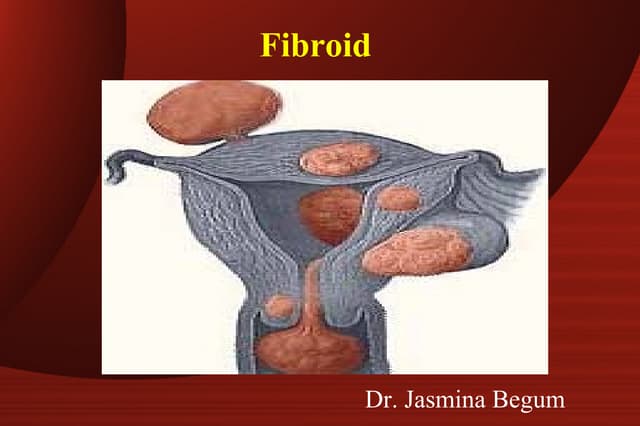 Uterine fibroids | PPTX