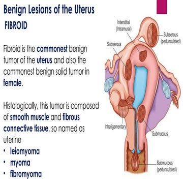 FIBROID gynecology detailed lecture.pptx