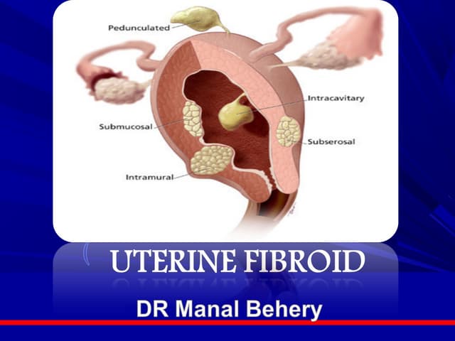 Uterine fibroids | PPTX