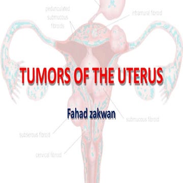 fibroids-150512150851-lva1-app6892.pptx