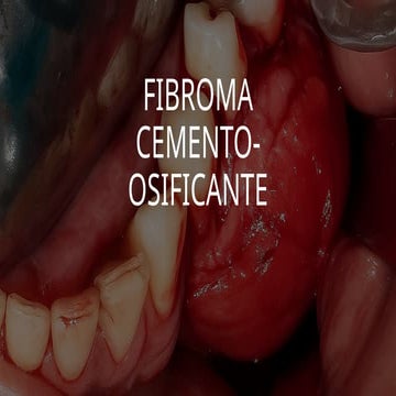 Fibroma cemento osificante final maxilofacial .pptx