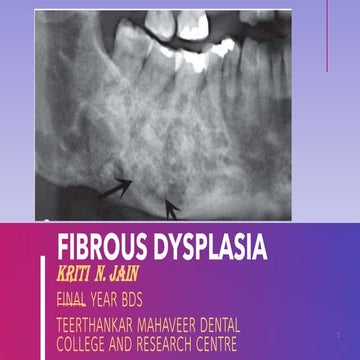 Fibrous Dysplasia Maxilla 