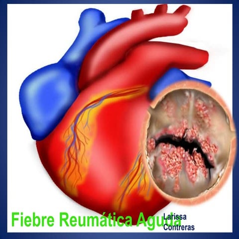 Fiebre reumática aguda