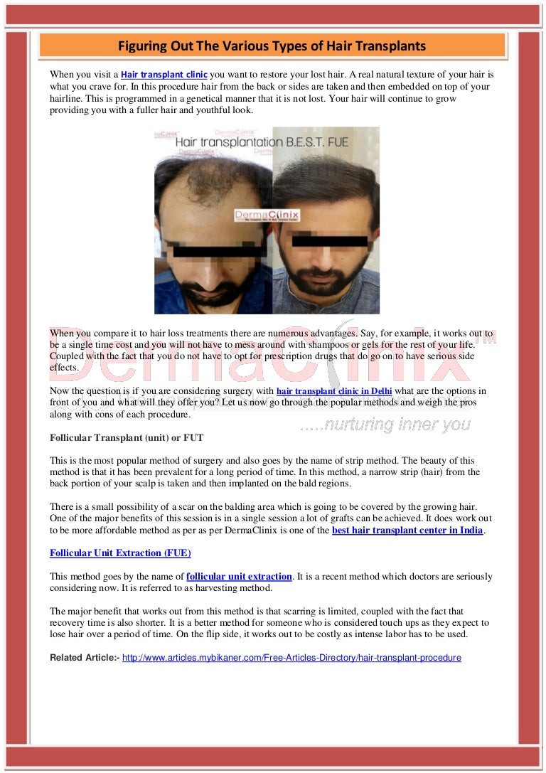 Figuring Out The Various Types Of Hair Transplants