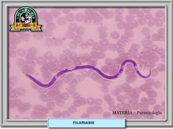 Filariasis (2) | PPT