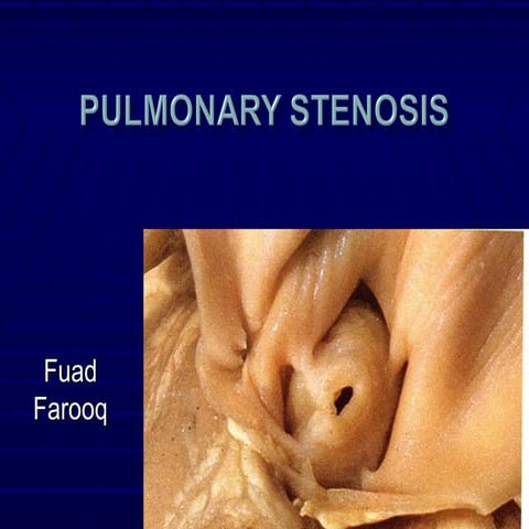 Finaale pulmonary stenosis