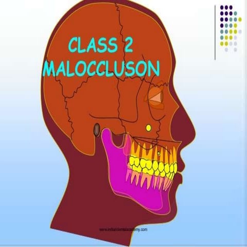 class 2 malocclusion