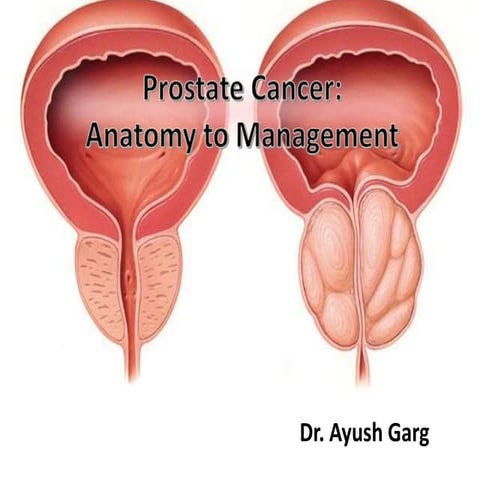 CA Prostate