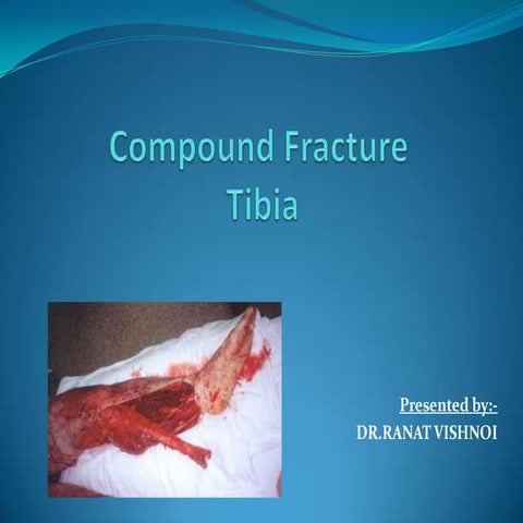 Compound Fracture Tibia