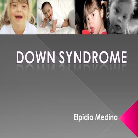 Down Syndrome Presentation