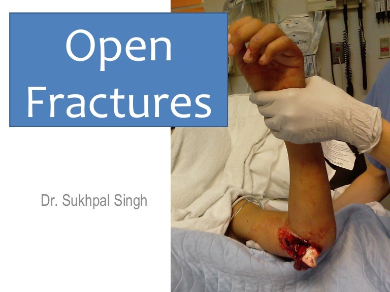 management of open fracture