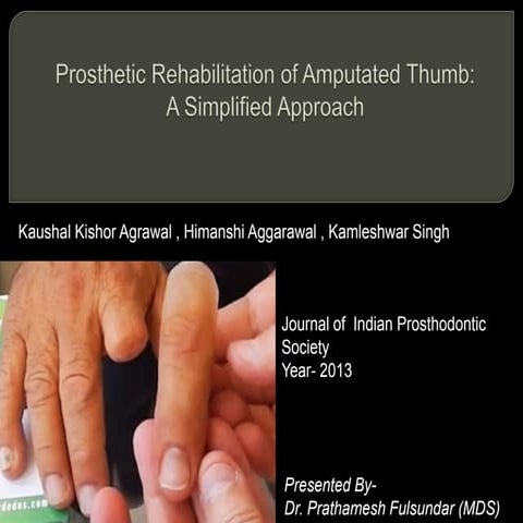 Finger prosthesis- Journal Club