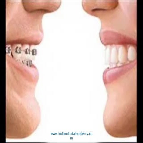 Finishing and detailing in straight wire technique / fixed orthodontics courses