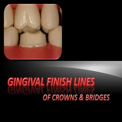 Different gingival finish lines (margins) of crowns and bridges | PPTX