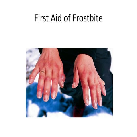 Frost bite | PPTX