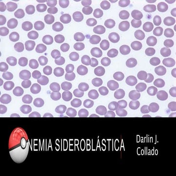 Anemia sideroblástica 