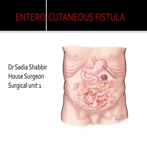 fistula, causes, risks  complications.pptx