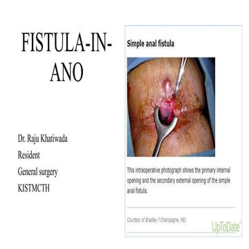 Fistula in ano 