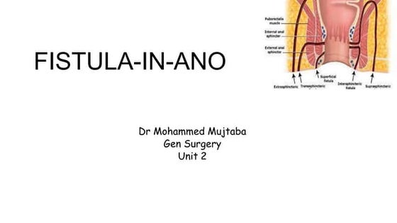 Anal Fistula | PPTX | Digestive Disorders | Diseases and Conditions